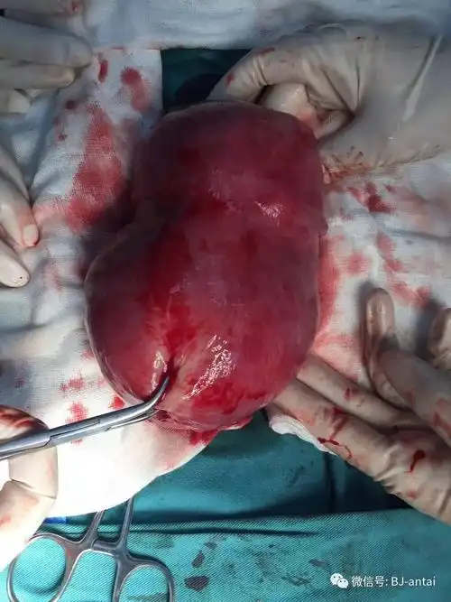 头样大的腺肌瘤让她疼的死去活来