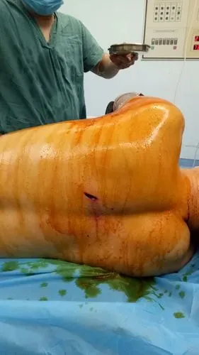 患者因背部刀刺伤伴伤口流血2小入院