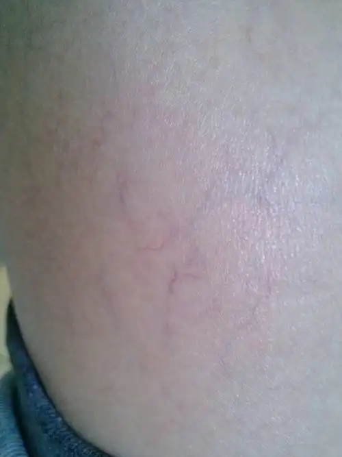 皮下毛细血管太明显,局部地方看上去很明显,发红发紫!