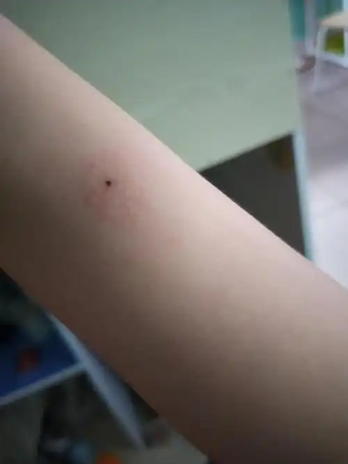 ppd皮试好像长水泡了