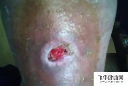 皮肤蝇蛆病的治疗