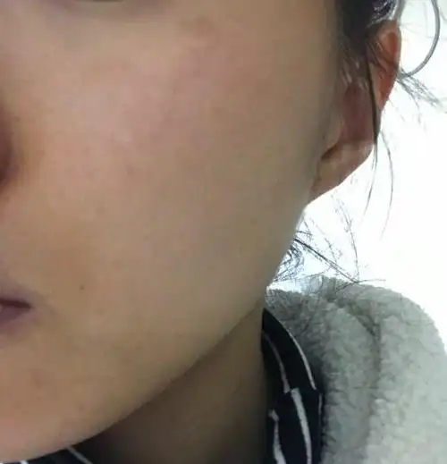 激光祛褐青斑颜色好像变深了-张敬东副主任医师-爱问医生