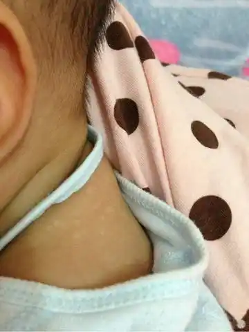哪位有经验的宝妈可以告诉我宝宝身上长这种白点是什么毛病吗 越来越
