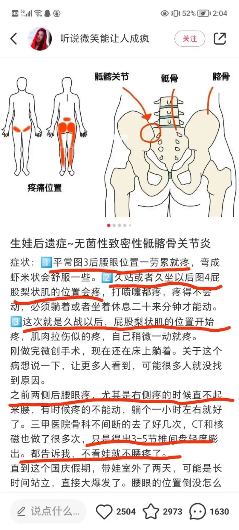骶髂关节疼.睡不着,看了评论区才真的是感同身受,好多人也有疼 - 抖音