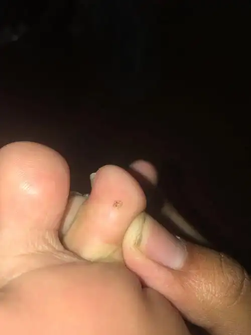 1条回答  这个像疣子 建议皮肤性科检查处理 一般都是液氢冷冻处理.