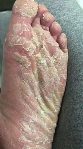 脚底严重脱皮,不痛不痒