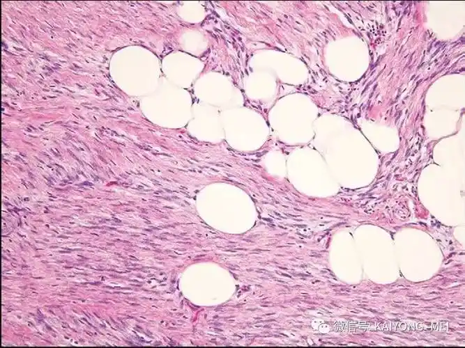 乳腺梭形细胞病变的病理诊断及进展(一)