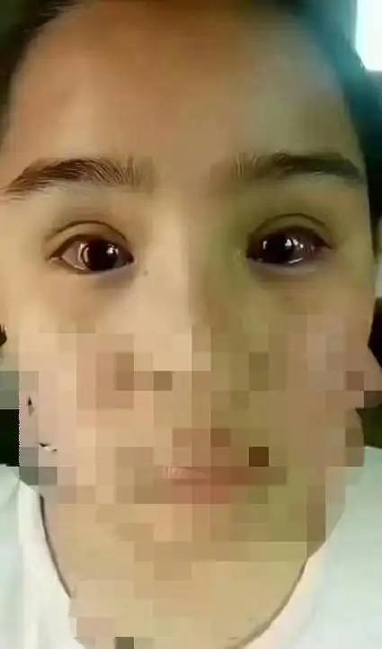 担心的事情真的发生了孩子玩手机导致眼睛失明