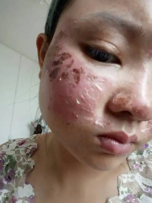 药水点斑了可以用橄榄油涂抹吗