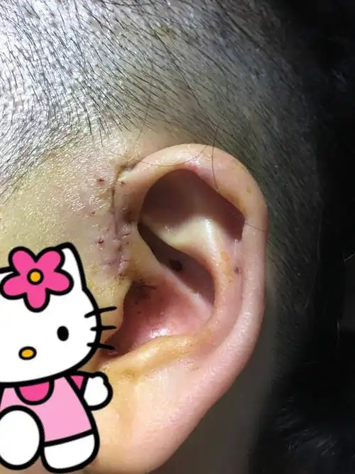患有先天性耳前瘘管是一种怎样的体验? - 知乎
