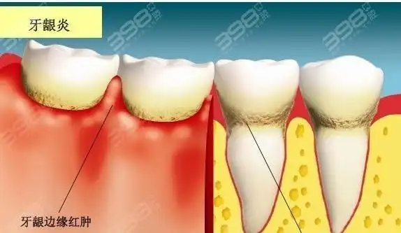牙龈炎牙周炎牙髓炎名字这么像到底有什么区别
