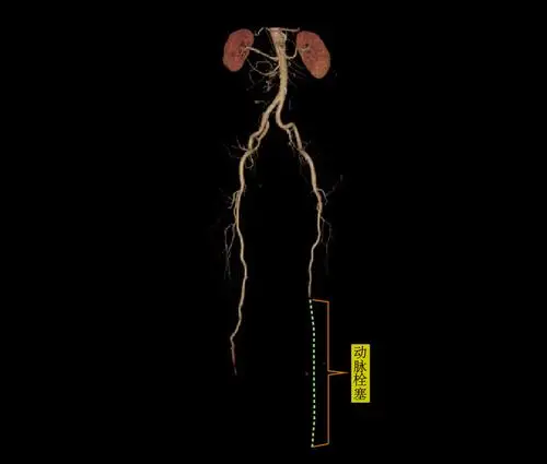 图为患者术前下肢动脉ct血管成像