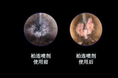 尖锐湿疣复发初期症状图片怎么治疗