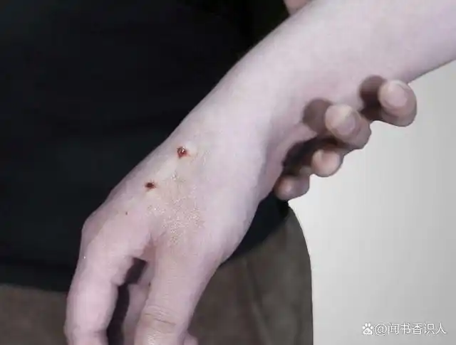 一男子被狗咬伤拇指,一个月后发现指骨被"吃"空,原因让人唏嘘