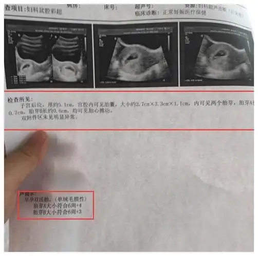 一个孕囊俩胚芽,孕妈喜怀双胞胎,三种双胞胎形式你了解几个?