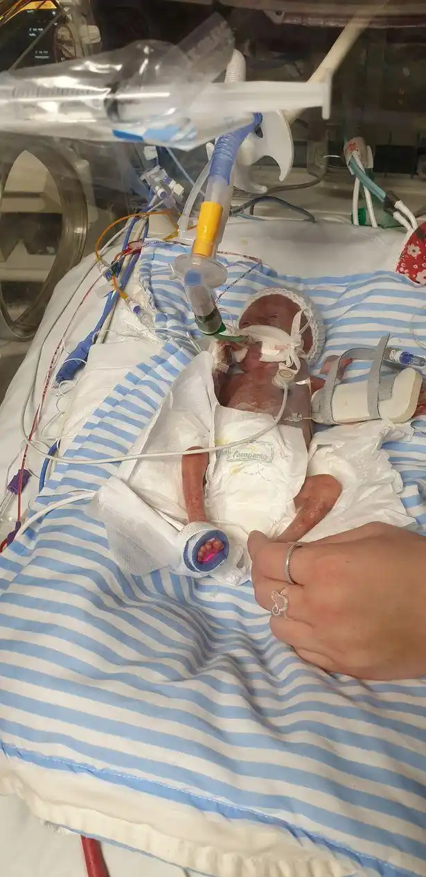 英早产儿在23周时出生,仅1斤重比电视遥控器还小,竟奇迹存活