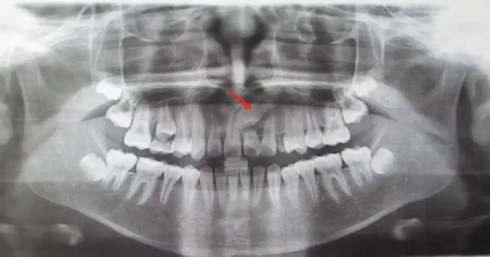 淘气的新牙,又长歪了,为什么你总不走寻常路?-郑梅钗主治医师-爱问医