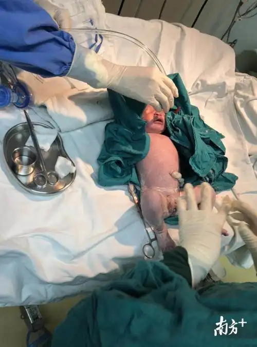 惊险产妇宫口开到一半突然胎心直降胎儿随时窒息医生2分钟娩出胎儿