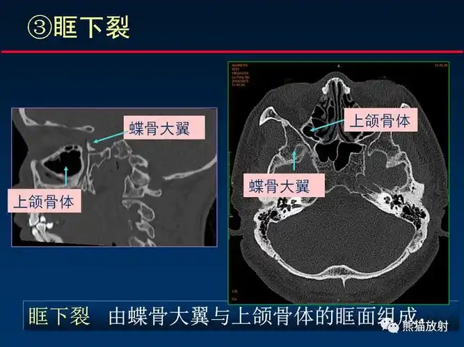【柳澄讲坛】颅底重要ct解剖及其临床意义