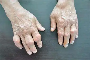双手手指疼痛是不是类风湿性关节炎,贵阳治类风湿病去哪家医院好