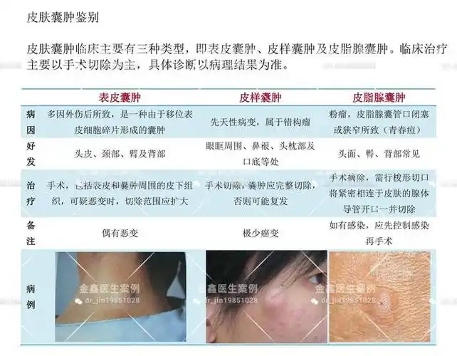 其中,皮肤囊肿主要有三种,即表皮囊肿,皮样囊肿和皮脂腺囊肿,各有不同