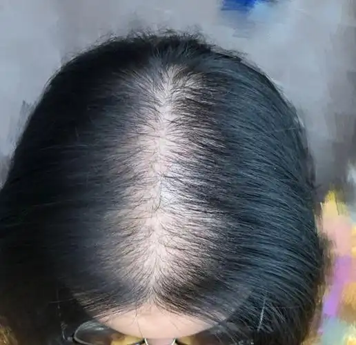 洗发水|头皮屑|脱发|水润丝_网易订阅