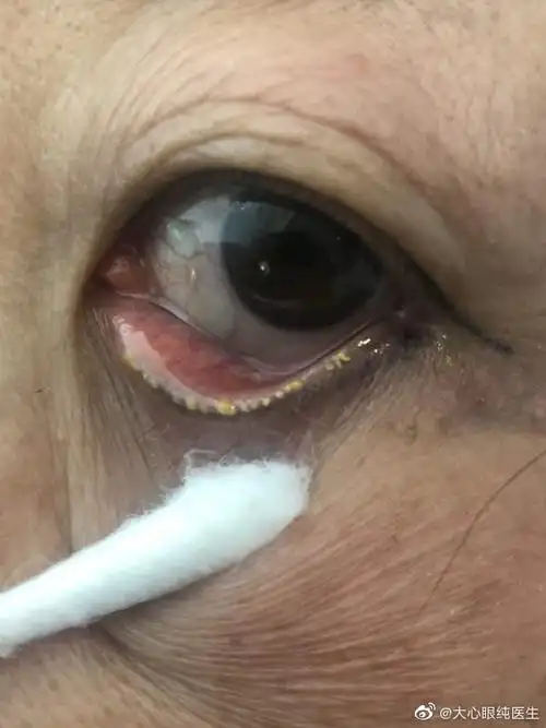 干眼杀手睑板腺功能障碍