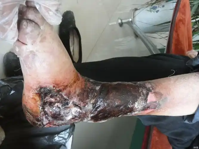 下肢闭塞性脉管炎破溃一例