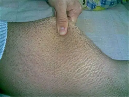 角样鱼鳞病图片_有来医生