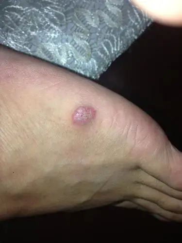 脚上长个包上面有开裂,有十多年了,刚开始很小,现在有点大,不痛不痒