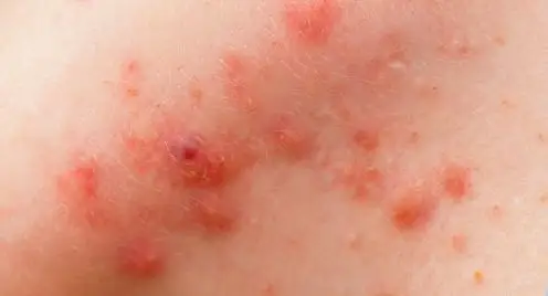 再怎么手痒也别挤这三种痘痘