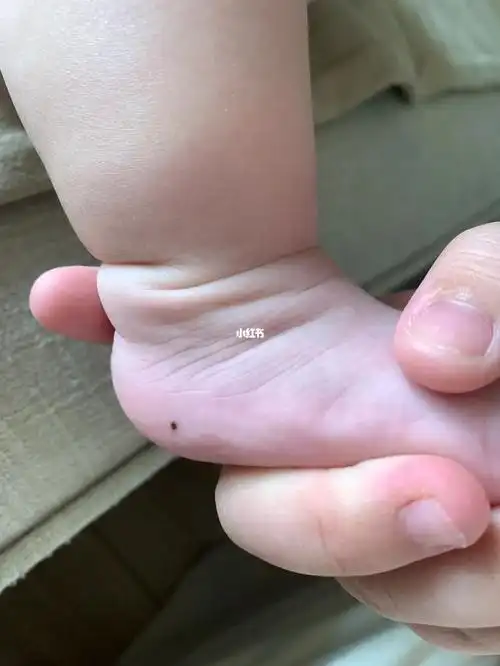 宝宝脚上长了个痣