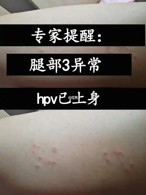 腿部3异常hpv已上身