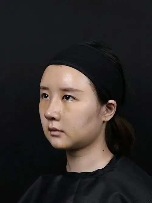 今天终于去拆线了,感觉我自己好久没有尝到大口呼吸的滋味了,鼻子里面