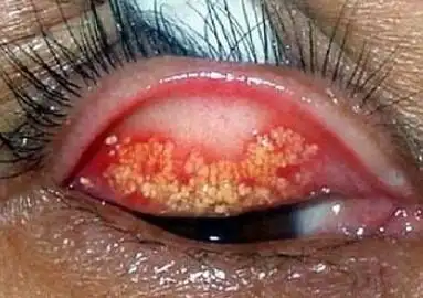 附上一张眼结石的图片,相当重口味,眼睛里面全是白色的密密麻麻的结石