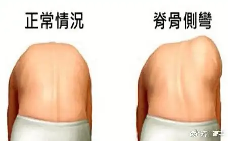 弯下腰,肉眼判断下后背是否有弯曲