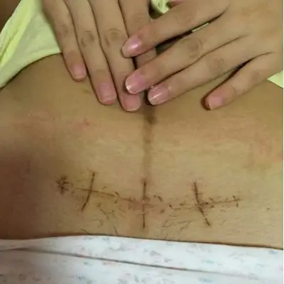 今天拆线第四天,剖腹产第11天,腹贴掉了,这样刀口是长好了么?