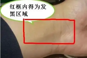 手腕扭伤,一周后内侧发黑.