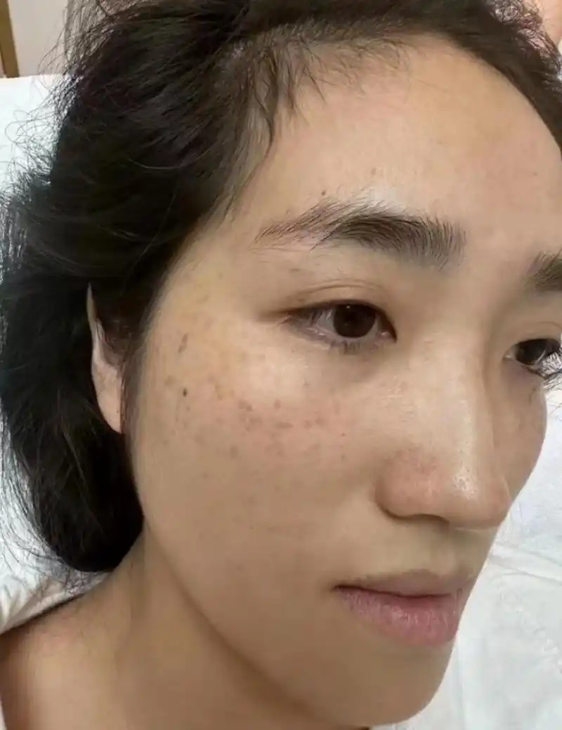 超皮秒祛斑是一种现代化的祛斑技术,它能够快速去除皮肤上的斑点和