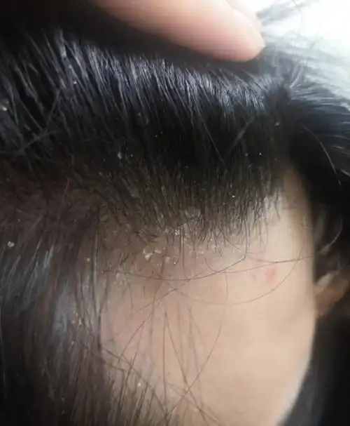 头皮屑多到一挠就跟下雪一样,怎么办?