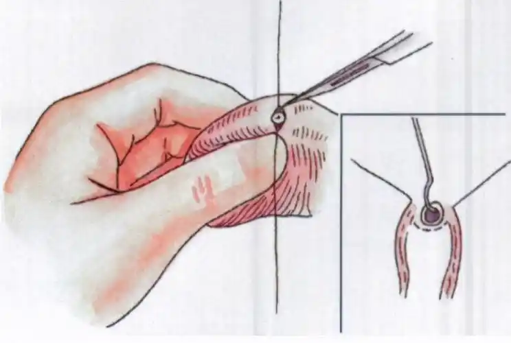 男人结扎要多少钱(曾经盛极一时的男性结扎术) - 价格百科