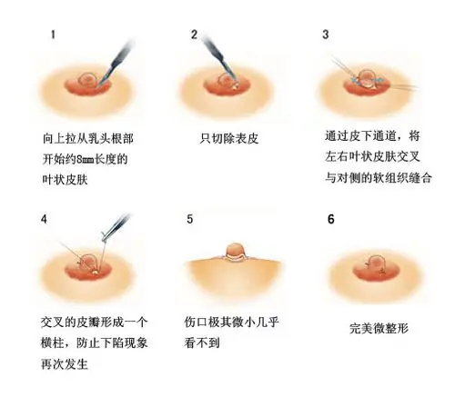 乳头内陷微创矫正术