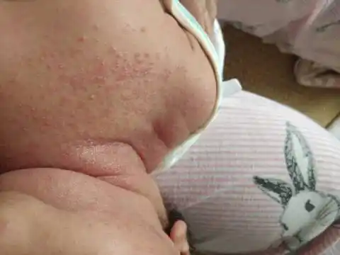 宝宝脖子下面长的湿疹还是热疹?