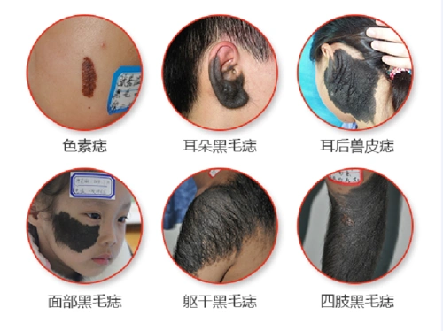 郑州市第二中医院科普:黑胎记长毛危险,要及早治疗哟!_手机搜狐网