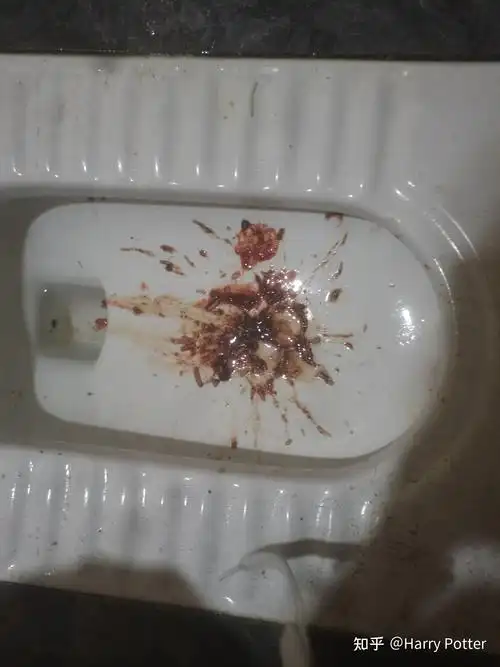 喝酒吐血是怎么回事? - 知乎