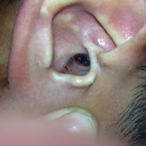 右耳朵里面长了好多脓包,流血浓.现在像塞住一样听力减少一半?