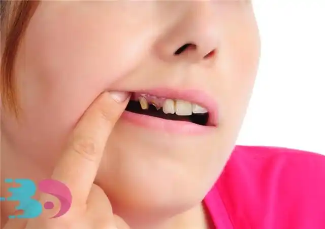 上火牙龈肿痛小妙招,牙龈肿痛有什么症状?