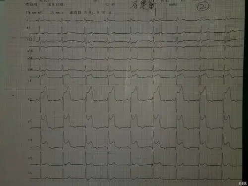 急性广泛前壁心肌梗死的典型心电图动态改变