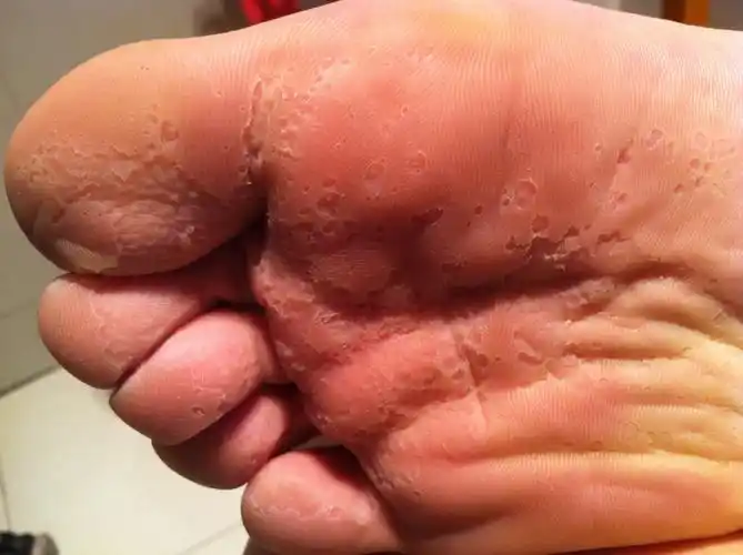 我的脚底板上有密密麻麻地小窟窿,不疼不痒,但是看起来很恐怖,附图