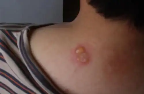 艾灸后起疙瘩皮肤痒红疹